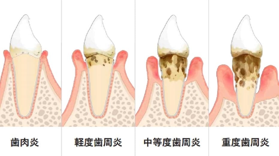 歯周病の治療の外観